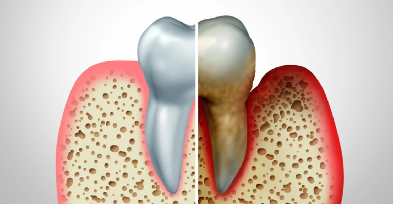 Is Periodontal Disease Hereditary INBLOG